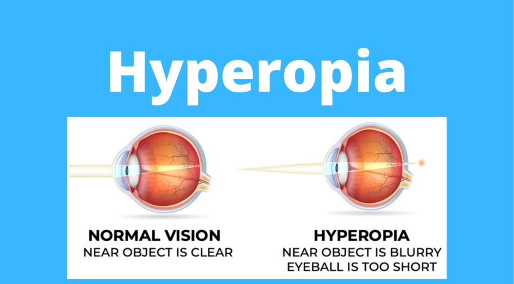 Hyperopia